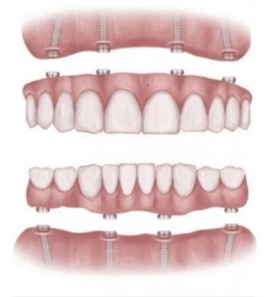 All-On-Implants Bridge / Teeth In A Day