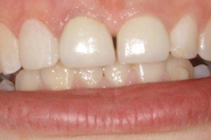 Porcelain Crowns After