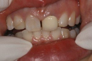 Porcelain Crowns Before