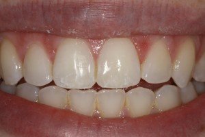 Enamel Microabrasion After