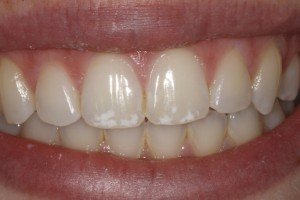 Enamel Microabrasion Before