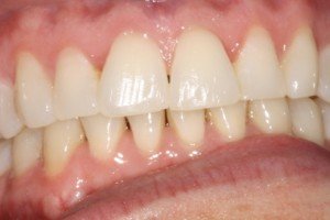 Cosmetic Re-shaping After