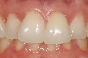 Cosmetic Re-shaping Before