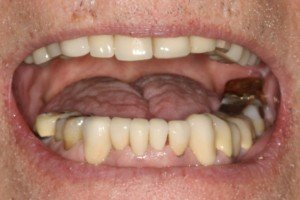 Crowns After