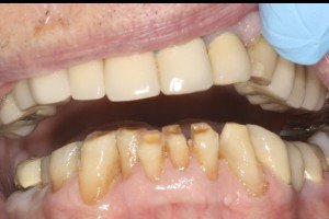 Crowns Before