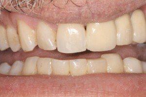 Porcelain Crown After