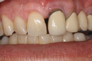 Porcelain Crown Before