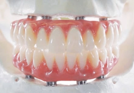 All-On-Implants Bridge / Teeth In A Day