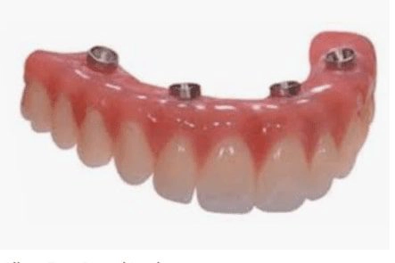 All-On-Implants Bridge / Teeth In A Day